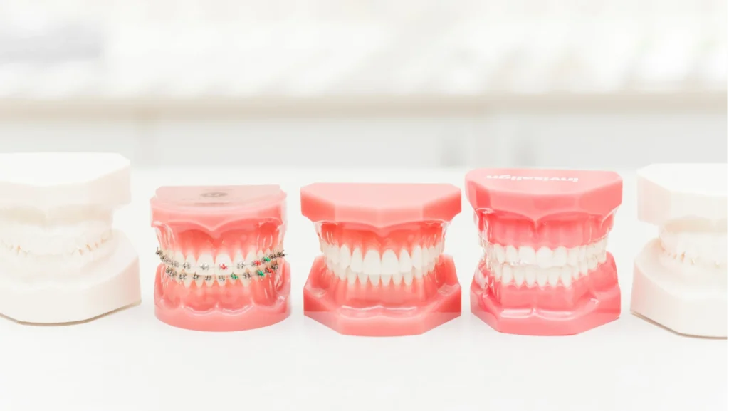 Avantages d’un traitement orthodontique