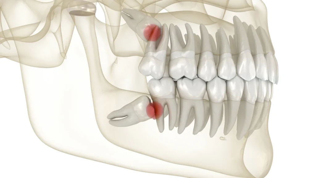 Extraction des dents de sagesse