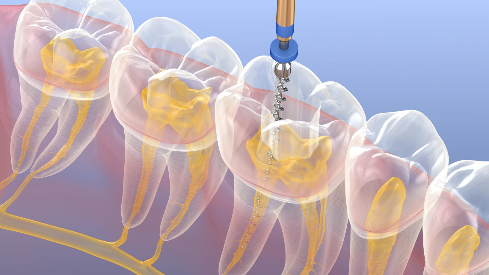 Devitalized tooth