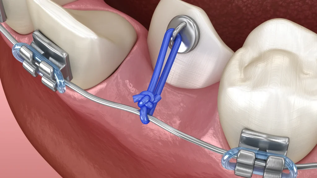 Dégagement des dents incluses