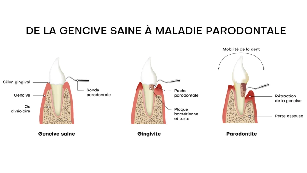 Maladies parodontales