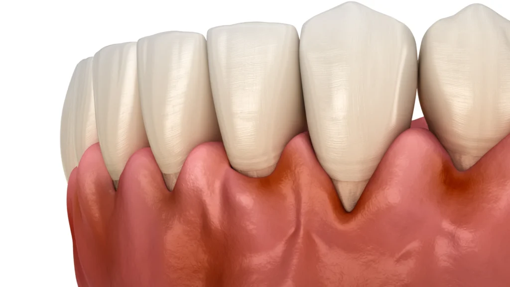 Periodontal surgery