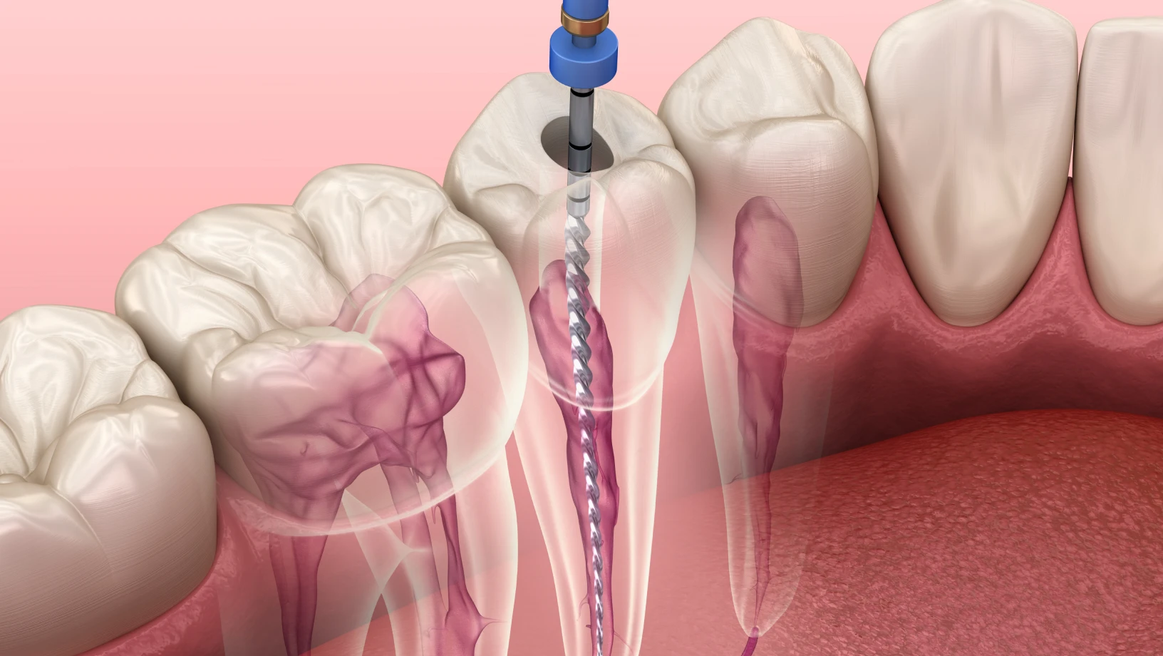 Root canal treatment