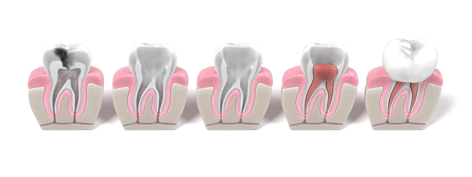 Root canal treatment