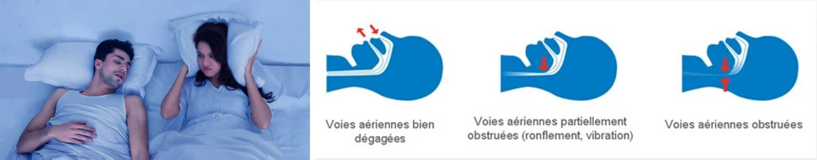 Traitement des apnées du sommeil