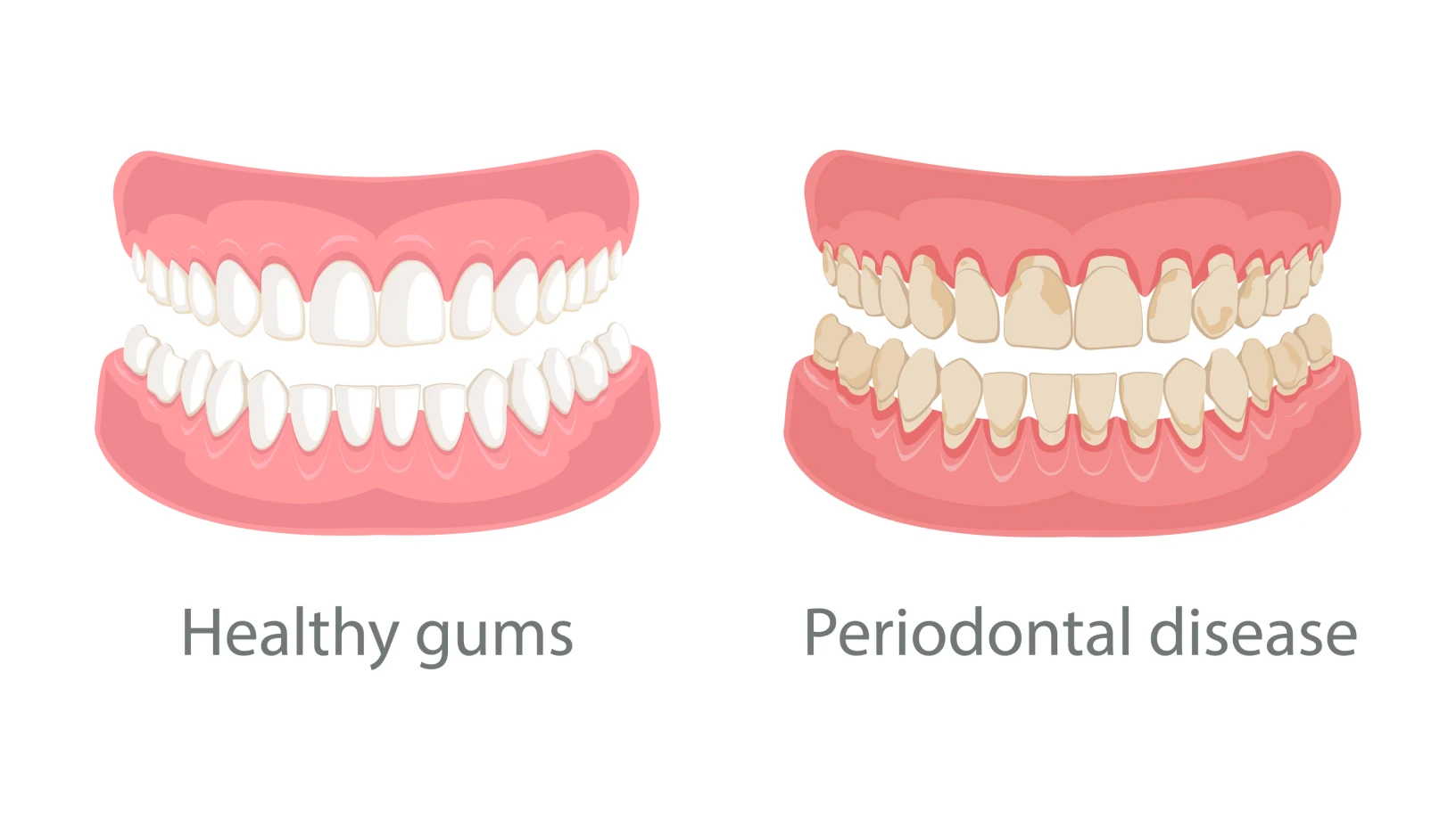 Gum diseases